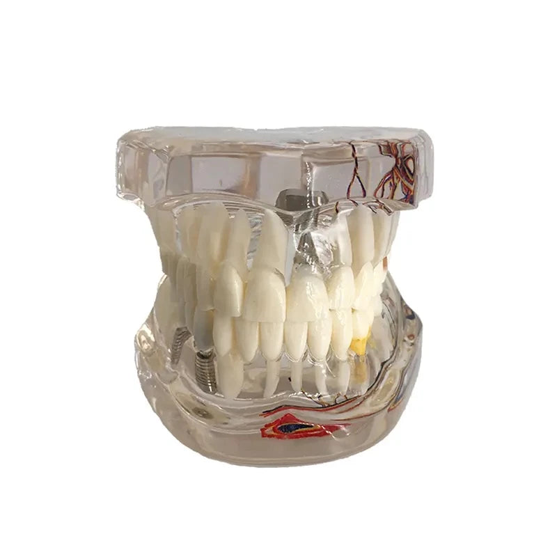 Dental Pathology Model