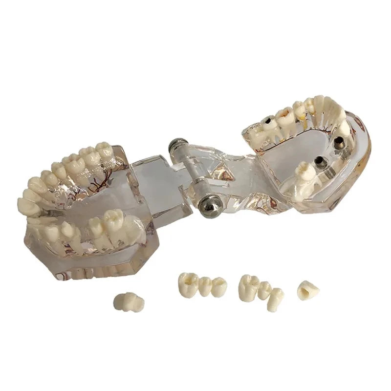 Dental Pathology Model